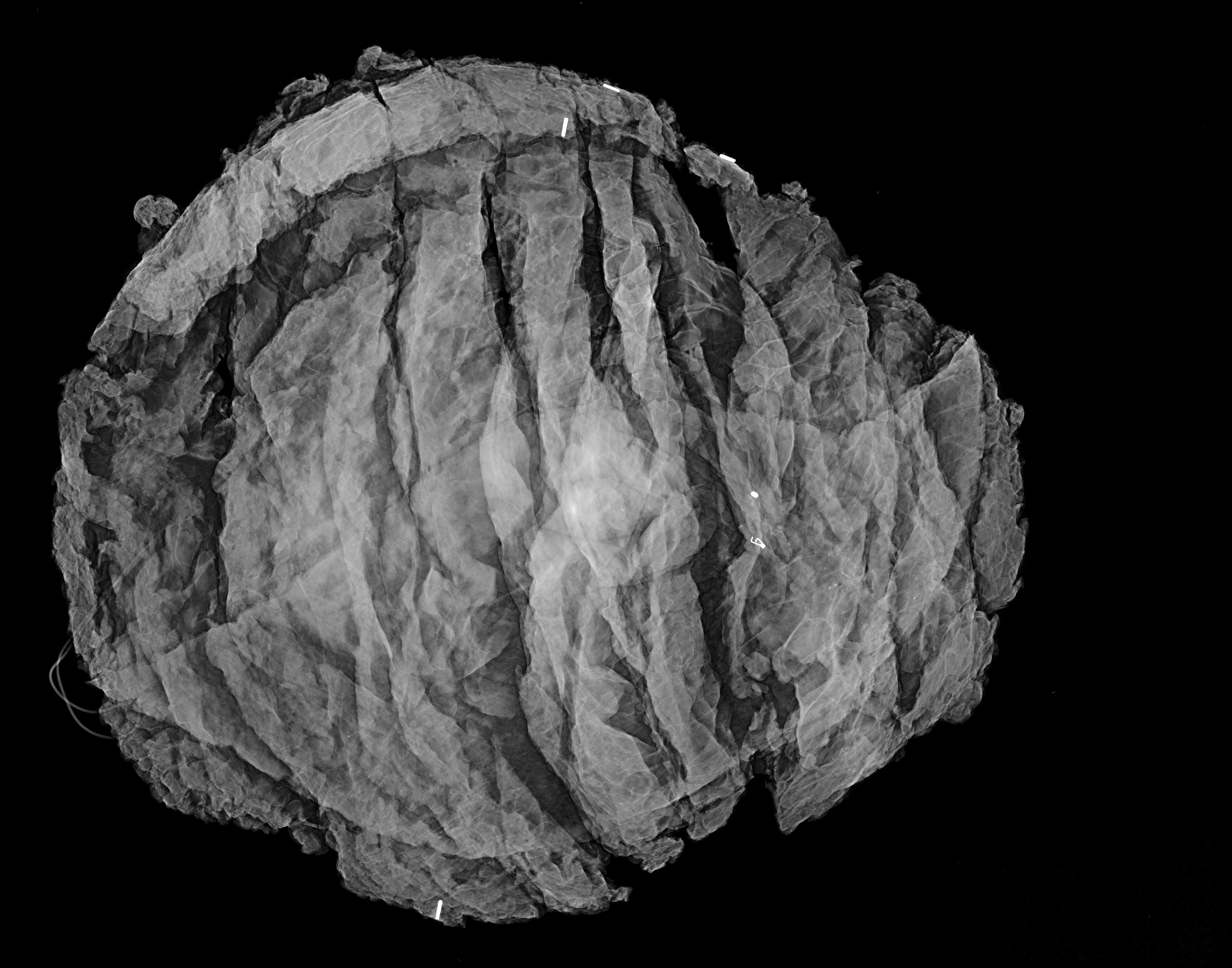 Mastectomy on PICASSO<sup>&reg;</sup> Plus